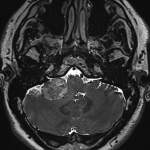 File:Acoustic schwannoma (Radiopaedia 50846-56358 Axial T2 13).png
