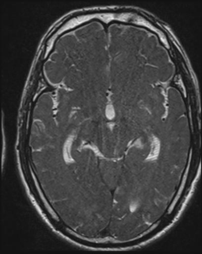File:Acoustic schwannoma - probable (Radiopaedia 20386-20292 Axial T1 66).jpg