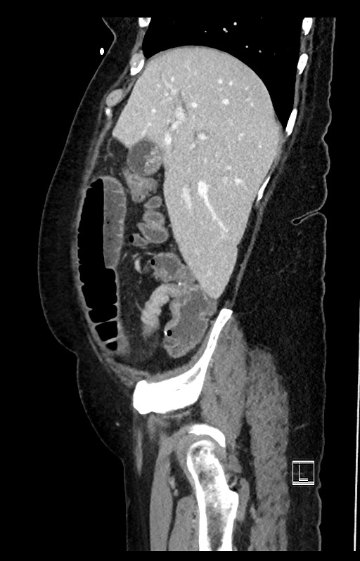 Active Crohn disease (Radiopaedia 59394-66750 Sagittal C+ portal venous phase 46).jpg