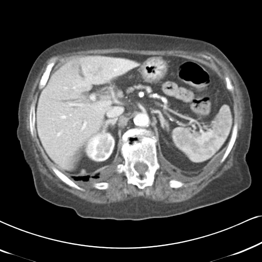 File:Active bleeding from duodenal ulcer with embolization (Radiopaedia 34216-35481 C 19).png