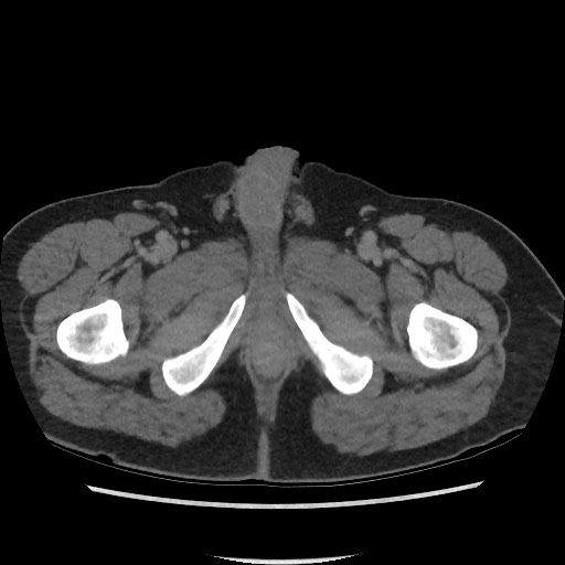 File:Active colonic bleed on CT (Radiopaedia 49765-55025 Axial C+ delayed 89).jpg