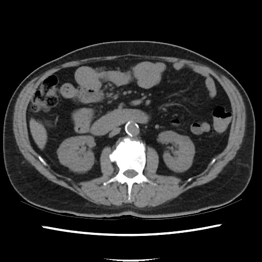 Active colonic bleed on CT (Radiopaedia 49765-55025 Axial non-contrast 35).jpg