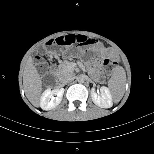 Active crohn disease (Radiopaedia 87133-103397 Axial C+ delayed 15).jpg