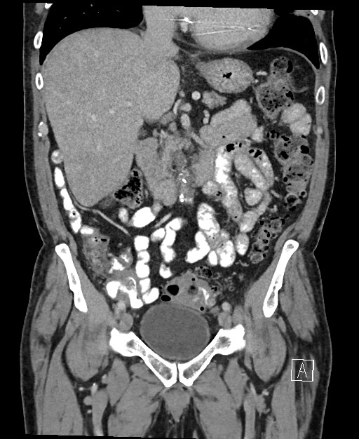 Active lower gastrointestinal bleeding - diverticular (Radiopaedia 61203-69106 Coronal C+ portal venous phase 62).jpg