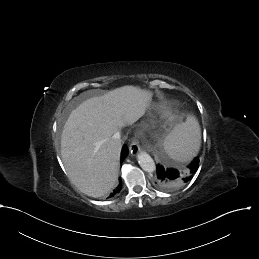 File:Active renal extravasation with large subcapsular and retroperitoneal hemorrhage (Radiopaedia 60975-68796 Axial 329).jpg
