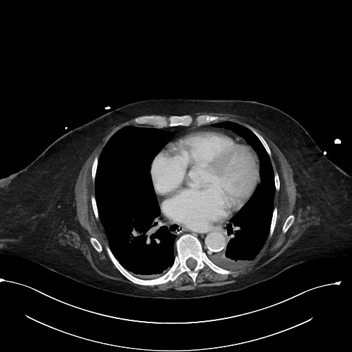 File:Active renal extravasation with large subcapsular and retroperitoneal hemorrhage (Radiopaedia 60975-68796 Axial 365).jpg