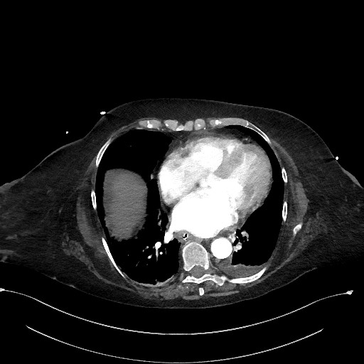 Active renal extravasation with large subcapsular and retroperitoneal hemorrhage (Radiopaedia 60975-68796 Axial C+ arterial phase 10).jpg