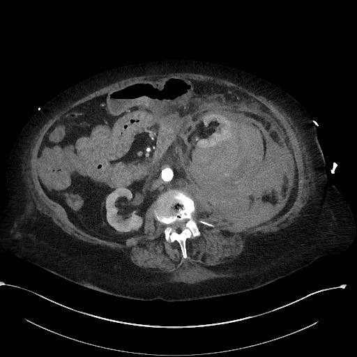 Active renal extravasation with large subcapsular and retroperitoneal hemorrhage (Radiopaedia 60975-68796 Axial C+ arterial phase 90).jpg