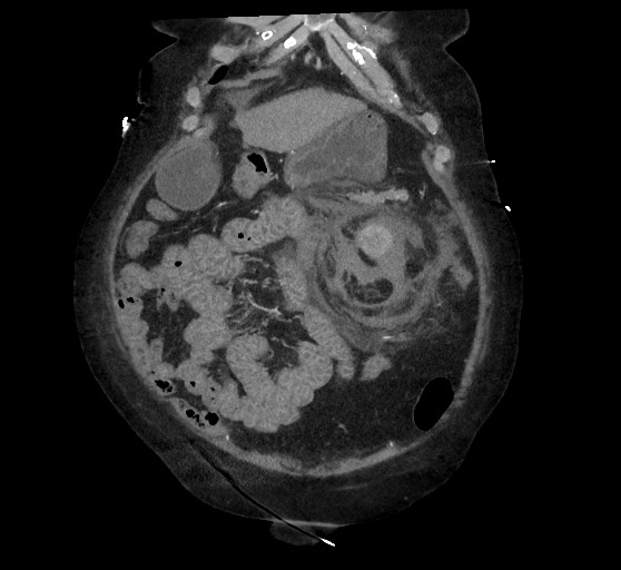 Active renal extravasation with large subcapsular and retroperitoneal hemorrhage (Radiopaedia 60975-68796 Coronal C+ arterial phase 41).jpg