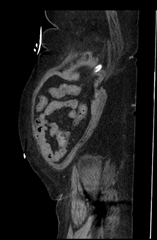 Active renal extravasation with large subcapsular and retroperitoneal hemorrhage (Radiopaedia 60975-68796 Sagittal C+ portal venous phase 189).jpg