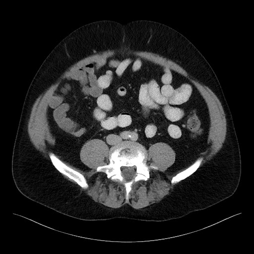 Acute-on-chronic pancreatitis (Radiopaedia 67286-76656 Axial C+ portal venous phase 51).jpg