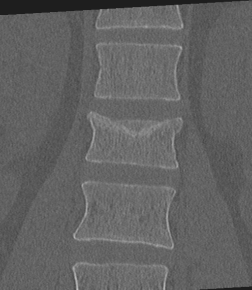 Acute L1 burst compression fracture (Radiopaedia 34430-35755 Coronal bone window 24).png