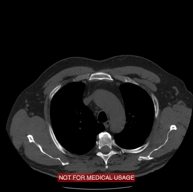 Acute aortic dissection - Stanford type A (Radiopaedia 40661-43285 Axial non-contrast 3).jpg