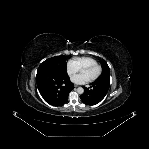 File:Acute appendicitis, heterotaxy syndrome (Radiopaedia 66884-76202 Axial C+ portal venous phase 4).jpg