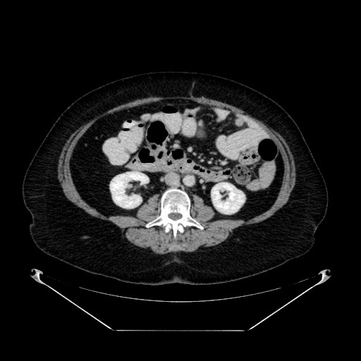 Acute appendicitis, heterotaxy syndrome (Radiopaedia 66884-76202 Axial C+ portal venous phase 64).jpg