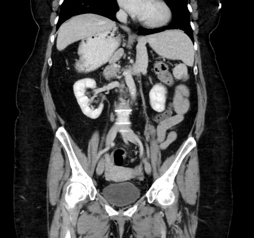 Acute appendicitis, heterotaxy syndrome (Radiopaedia 66884-76202 Coronal C+ portal venous phase 65).jpg