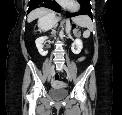 Acute appendicitis, heterotaxy syndrome (Radiopaedia 66884-76202 Coronal C+ portal venous phase 69).jpg