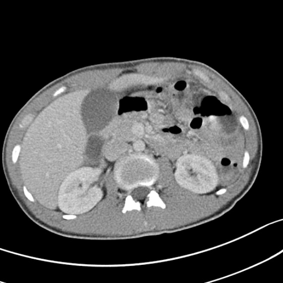 Acute appendicitis (Radiopaedia 32614-33572 Axial C+ portal venous phase 23).jpg