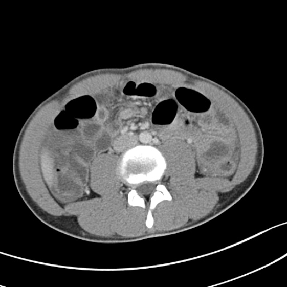 Acute appendicitis (Radiopaedia 32614-33572 Axial C+ portal venous phase 35).jpg