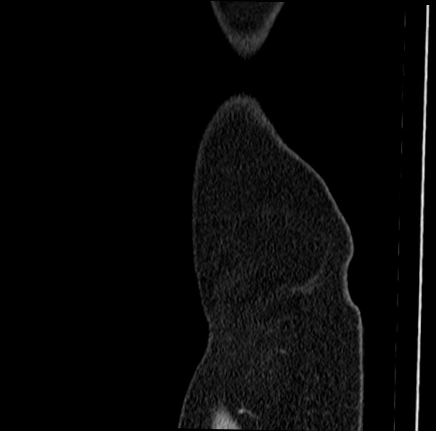 Acute appendicitis (Radiopaedia 38255-40270 Sagittal C+ portal venous phase 86).jpg