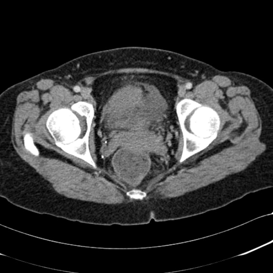 File:Acute appendicitis (Radiopaedia 48792-53822 Axial C+ portal venous phase 111).jpg
