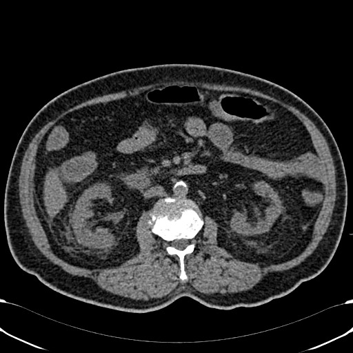 Acute appendicitis (Radiopaedia 58627-65818 Axial non-contrast 40).jpg