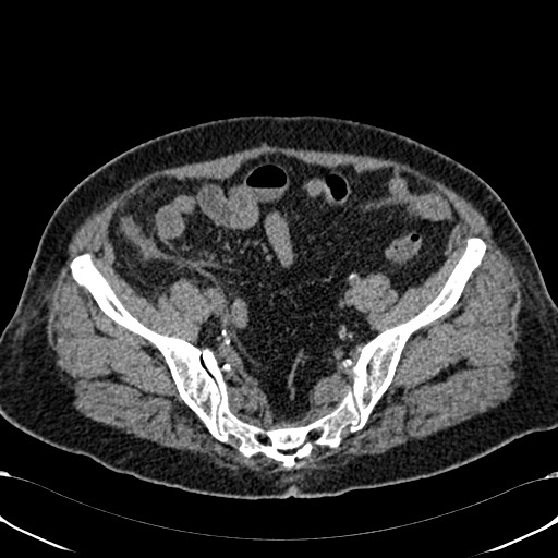 File:Acute appendicitis (Radiopaedia 58627-65818 Axial non-contrast 69).jpg