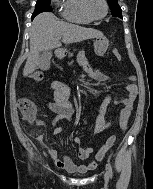 Acute appendicitis (Radiopaedia 58627-65818 Coronal non-contrast 33).jpg