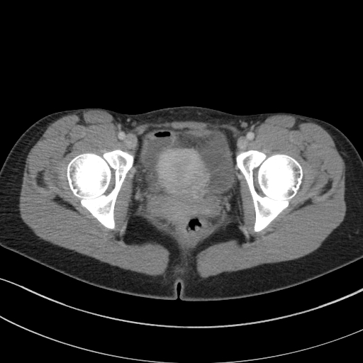 Acute appendicitis (Radiopaedia 62608-70901 Axial C+ portal venous phase 54).jpg