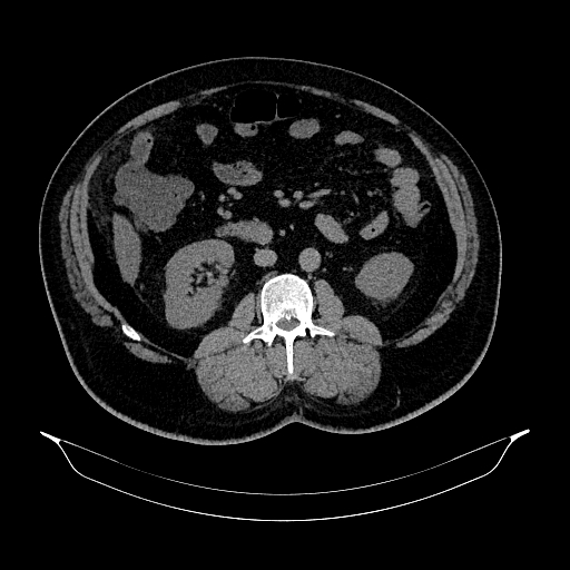 Acute appendicitis (Radiopaedia 79950-93224 Axial non-contrast 49).jpg