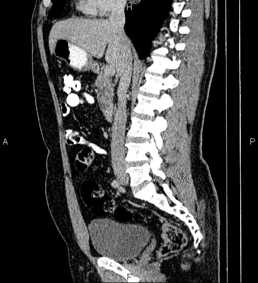 Acute appendicitis (Radiopaedia 84780-100240 Sagittal C+ portal venous phase 47).jpg