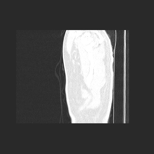 Acute appendicitis and COVID 19 pneumonia (Radiopaedia 76604-88380 Sagittal lung window 2).jpg