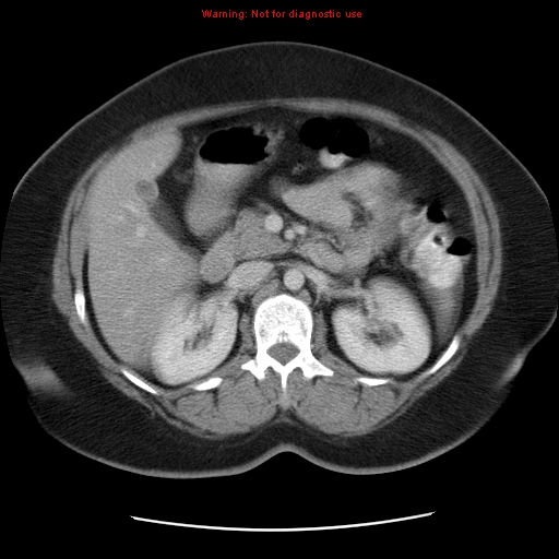 Acute appendicitis complicated by ovarian vein thrombophlebitis (Radiopaedia 16172-15851 Axial C+ portal venous phase 37).jpg