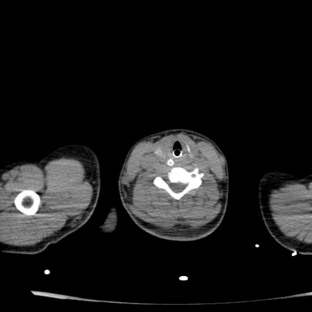 Acute aspiration pneumonitis (Radiopaedia 33605-34703 Axial non-contrast 5).jpg