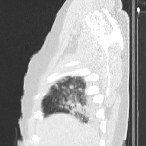 Acute aspiration pneumonitis (Radiopaedia 33605-34703 Sagittal lung window 13).jpg