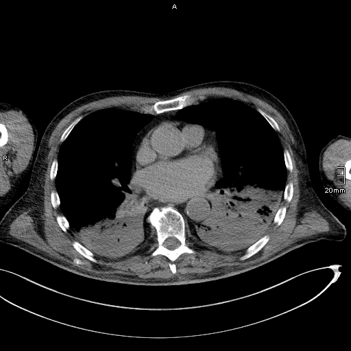 File:Acute aspiration pneumonitis (Radiopaedia 55642-62166 Axial liver window 36).jpg