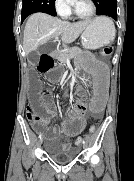 Acute bowel ischemia (Radiopaedia 87695-104114 Coronal C+ portal venous phase 174).jpg