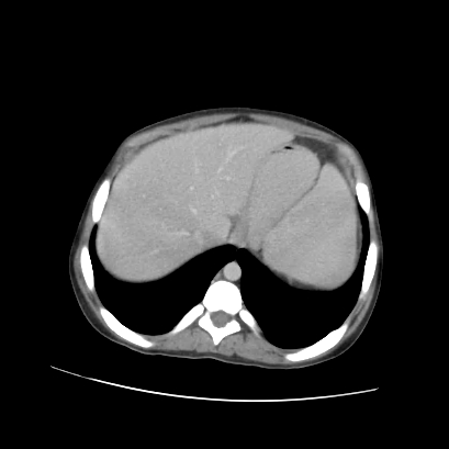 Acute calculous cholecystitis in patient with osteopetrosis (Radiopaedia 77871-90159 Axial C+ portal venous phase 20).jpg