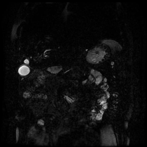 Acute cholecystitis and biliary hamartomas (Radiopaedia 86231-102240 E 114).jpg