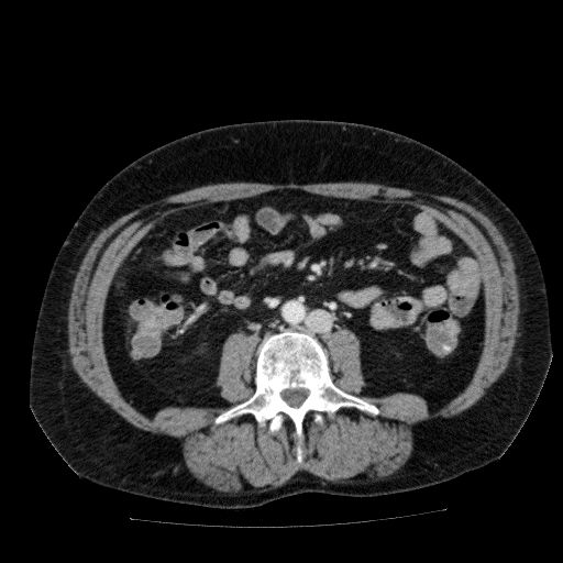 Acute cholecystitis and incidental left sided IVC (Radiopaedia 49352-54459 Axial C+ portal venous phase 85).jpg