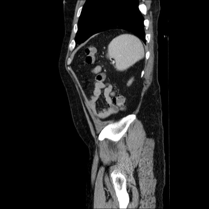 Acute cholecystitis and incidental left sided IVC (Radiopaedia 49352-54459 Sagittal C+ portal venous phase 21).jpg