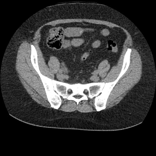 File:Acute cholecystitis and ureteric colic (Radiopaedia 42330-45444 Axial prone 81).jpg