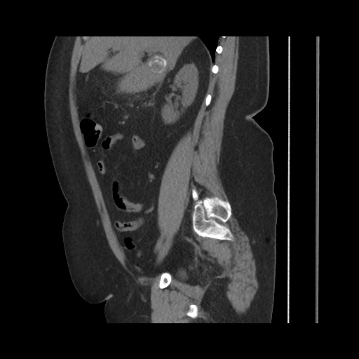 Acute cholecystitis with tensile fundus sign (Radiopaedia 71394-81723 Sagittal non-contrast 71).jpg