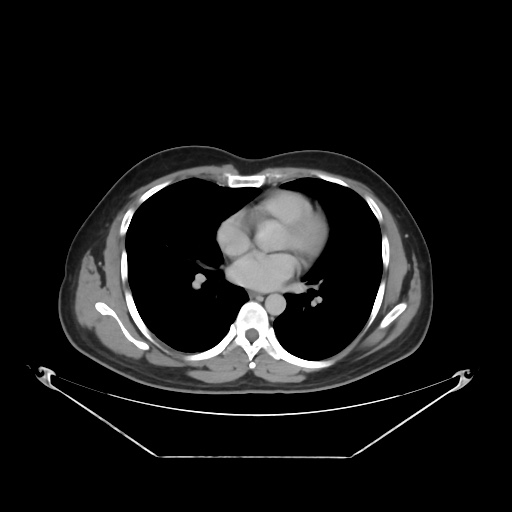 File:Acute complicated calculous cholecystitis (Radiopaedia 55202-61587 Axial C+ delayed 8).jpg