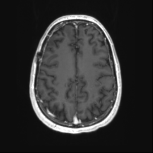 Acute disseminated encephalomyelitis (ADEM) (Radiopaedia 65319-74350 Axial T1 C+ 47).png