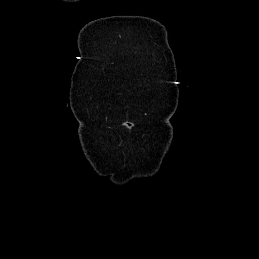 Acute diverticulitis - transverse colon (Radiopaedia 87063-103327 Coronal C+ portal venous phase 19).jpg