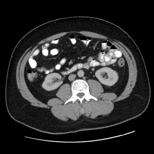 File:Acute diverticulitis with localized perforation (Radiopaedia 41296-44113 Axial C+ portal venous phase 46).jpg
