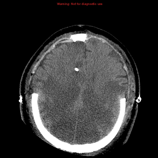 Acute hemorrhagic leukoencephalitis (Radiopaedia 14076-43697 Axial non-contrast 34).jpg