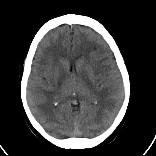 File:Acute middle cerebral arterial embolus (Radiopaedia 3956-6518 Axial non-contrast 1).jpg