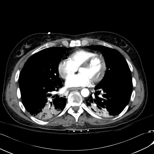 File:Acute myocardial infarction in CT (Radiopaedia 39947-42415 Axial C+ arterial phase 86).jpg